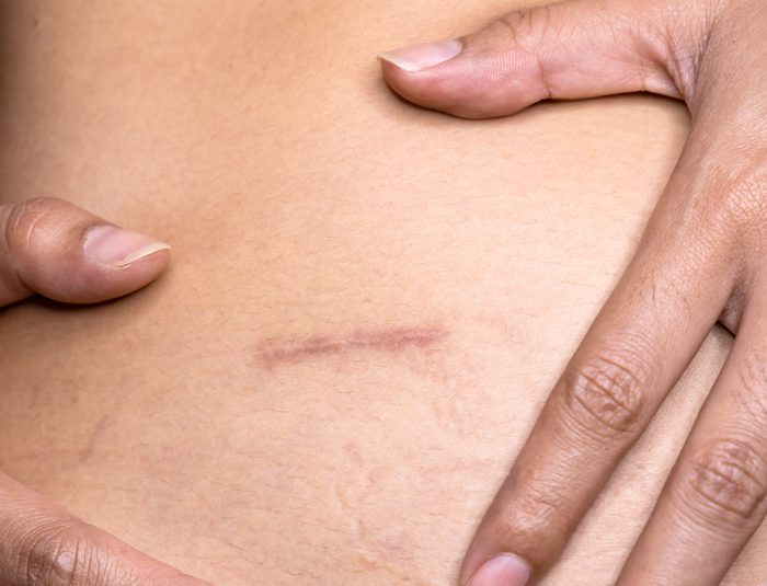 Cheshire cosmetic surgery scars