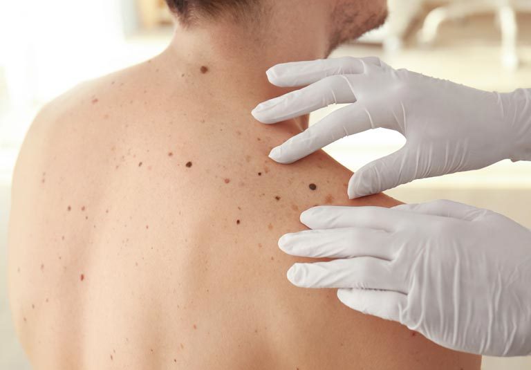 Skin Cancer & Mole Surgery Blog Featured Image