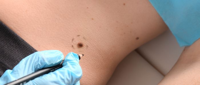 Skin Cancer and Mole Surgery