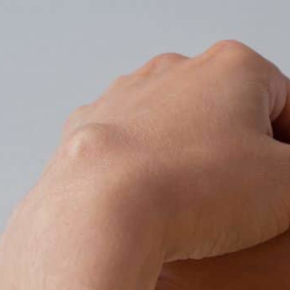 Ganglion Removal Surgery