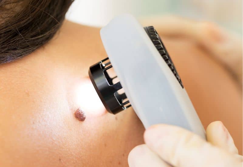 Skin Cancer Treatments