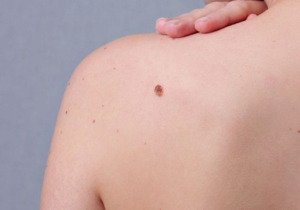 Moles Condition Featured Image