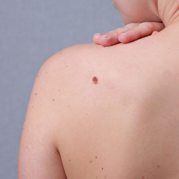 Moles