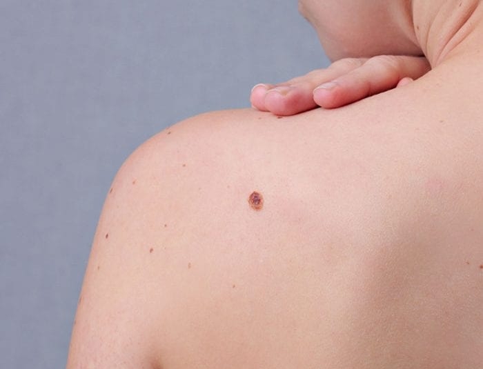 Moles Condition Featured Image