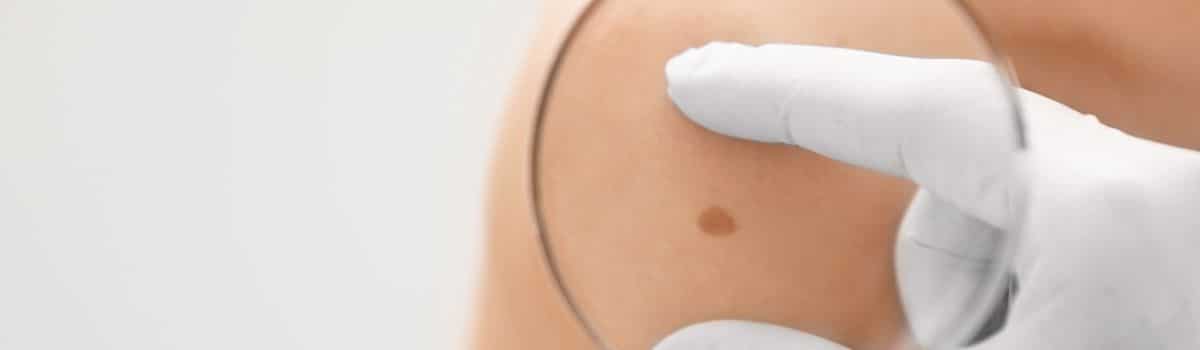 Skin mole removal