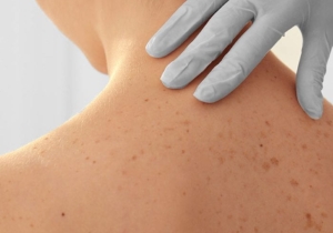 What Does Skin Cancer Look Blog Featured Image