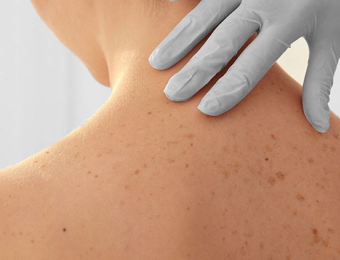 What Does Skin Cancer Look Like Cheshire Cosmetic Surgery