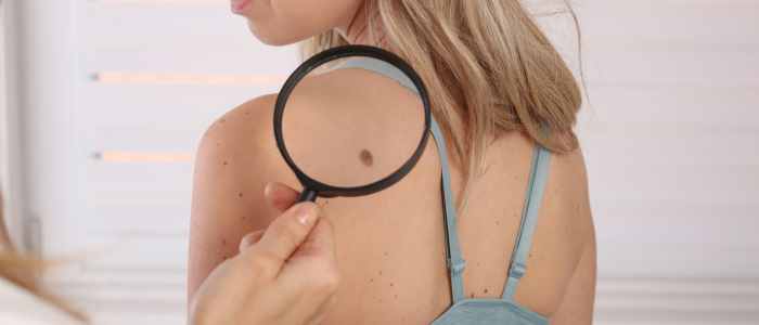 Recovery after skin tag removal