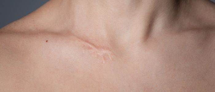 Options for scar treatment