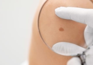 What to Expect During and After an Excision Biopsy for Suspected Skin Cancer