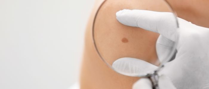 Excision biopsy for skin cancer