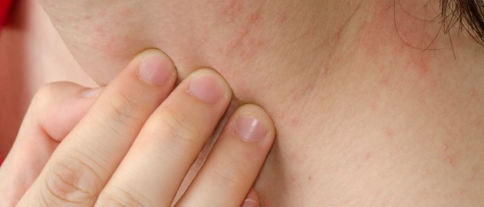 Causes for eczema