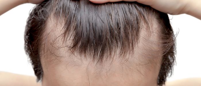 Causes of androgenic alopecia