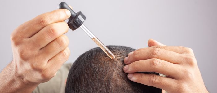 Minoxidil for pattern hair loss