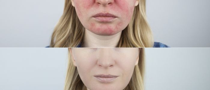 Rosacea treatment options